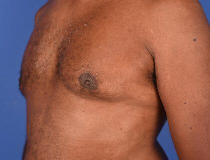 Gynecomastia Before & After Image