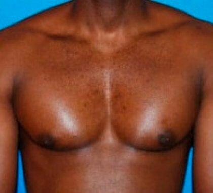 Gynecomastia Before & After Image