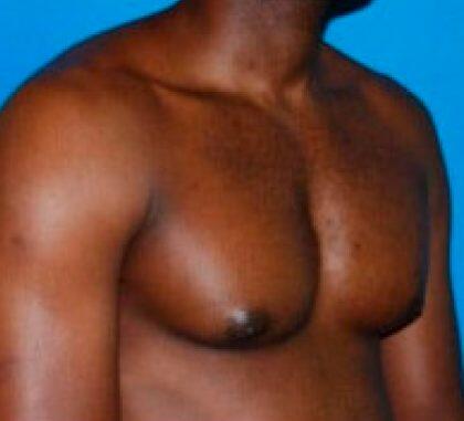 Gynecomastia Before & After Image