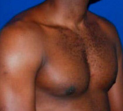 Gynecomastia Before & After Image