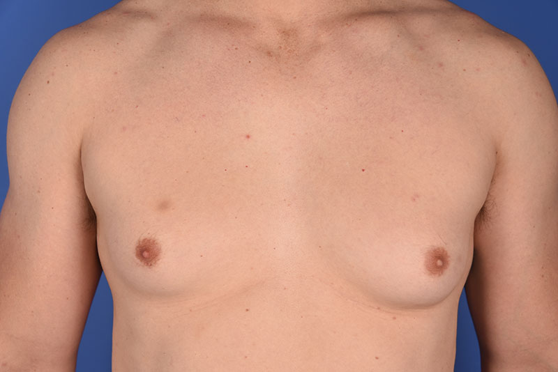 Gynecomastia Before & After Image