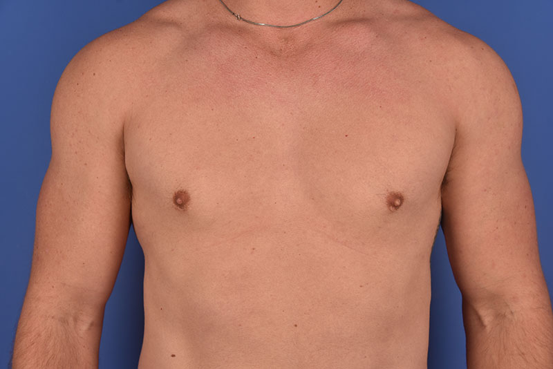 Gynecomastia Before & After Image