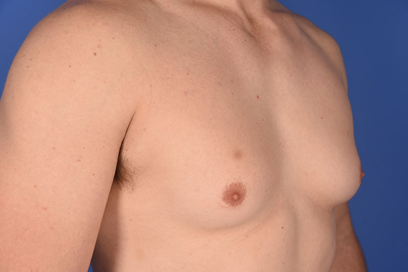 Gynecomastia Before & After Image