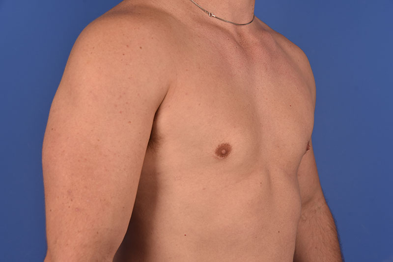 Gynecomastia Before & After Image