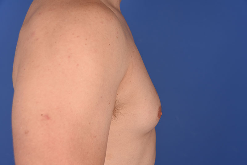 Gynecomastia Before & After Image