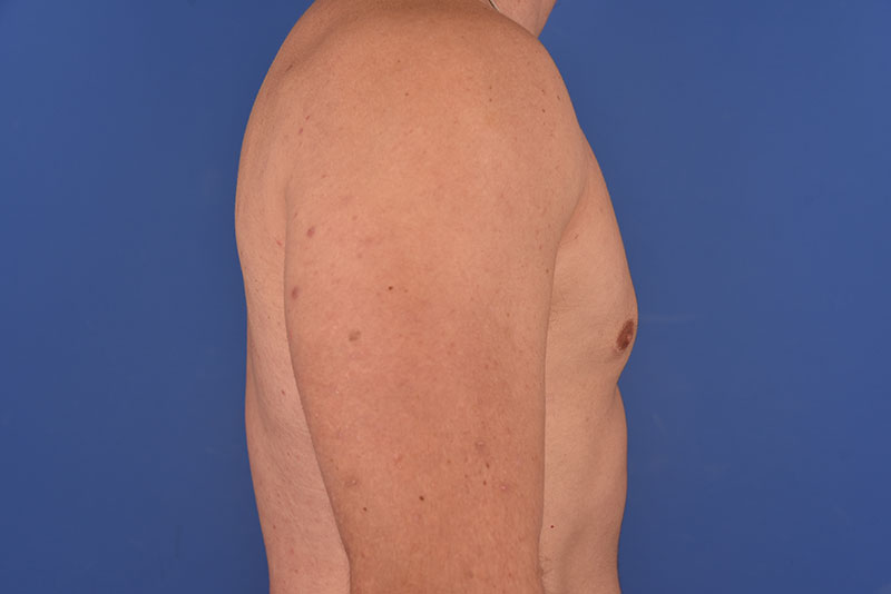 Gynecomastia Before & After Image