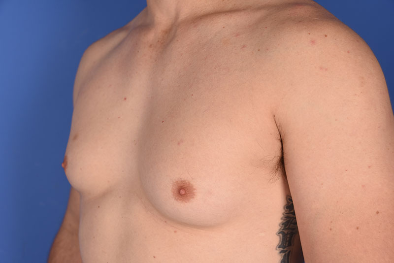 Gynecomastia Before & After Image