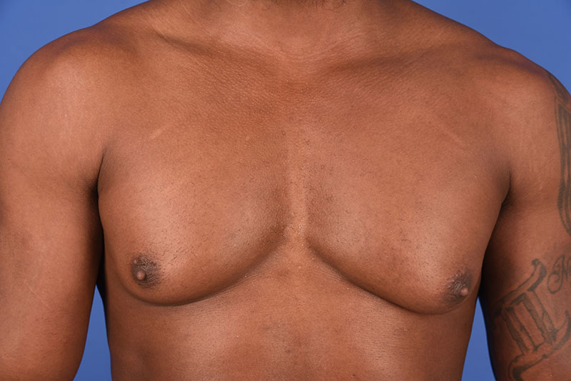 Gynecomastia Before & After Image