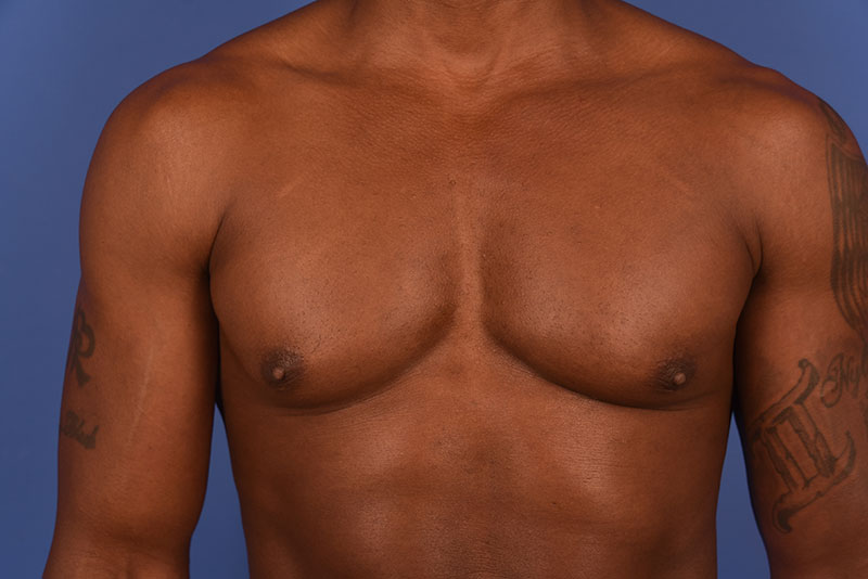 Gynecomastia Before & After Image