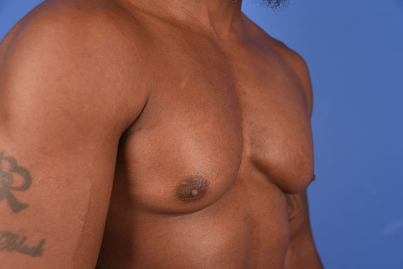 Gynecomastia Before & After Image