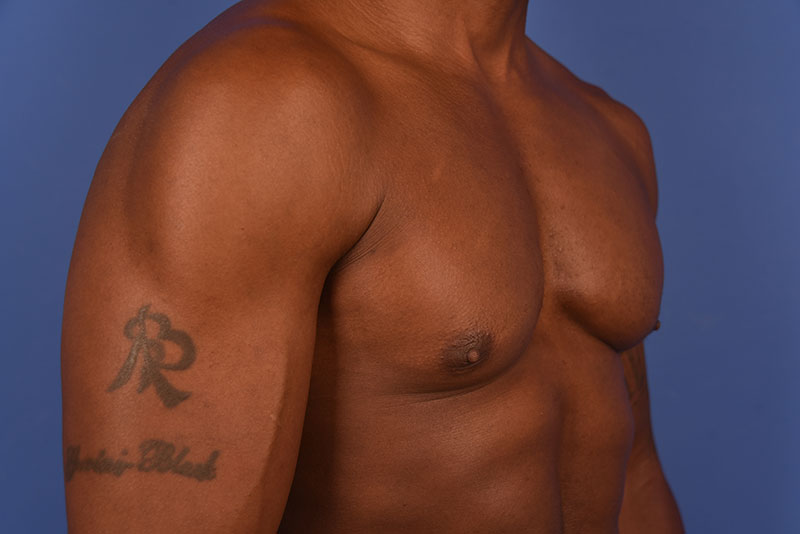 Gynecomastia Before & After Image