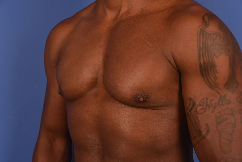 Gynecomastia Before & After Image
