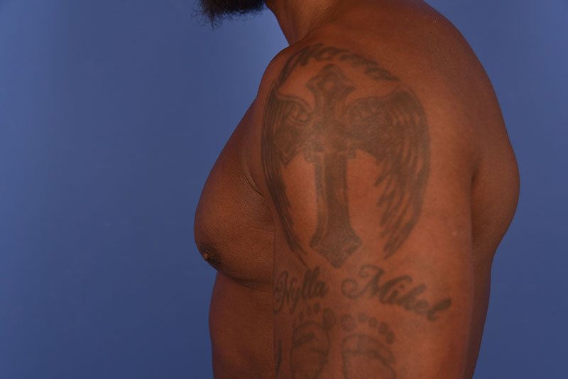 Gynecomastia Before & After Image