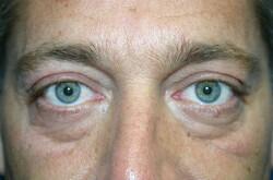 Blepharoplasty For Men Before & After Image