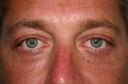 Blepharoplasty For Men Before & After Image