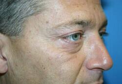 Blepharoplasty For Men Before & After Image
