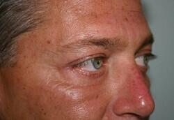 Blepharoplasty For Men Before & After Image