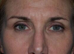 Blepharoplasty Before & After Image