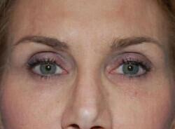 Blepharoplasty Before & After Image