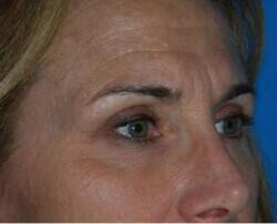 Blepharoplasty Before & After Image