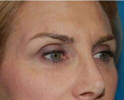 Blepharoplasty Before & After Image