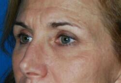 Blepharoplasty Before & After Image