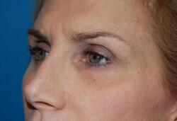 Blepharoplasty Before & After Image