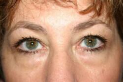 Blepharoplasty Before & After Image