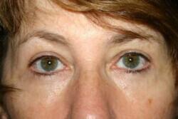 Blepharoplasty Before & After Image