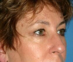 Blepharoplasty Before & After Image