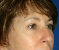 Blepharoplasty Before & After Image