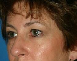 Blepharoplasty Before & After Image