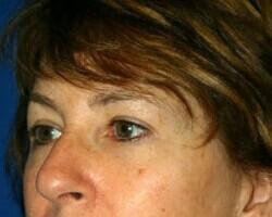 Blepharoplasty Before & After Image