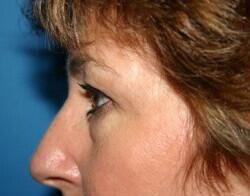 Blepharoplasty Before & After Image