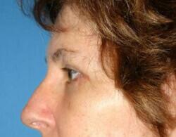 Blepharoplasty Before & After Image