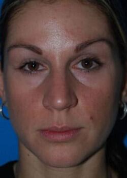 Blepharoplasty Before & After Image