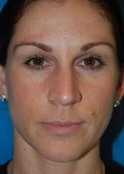 Blepharoplasty Before & After Image