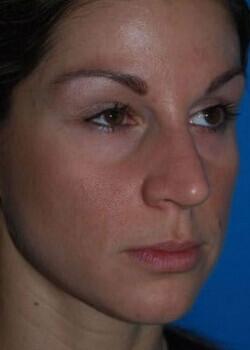 Blepharoplasty Before & After Image