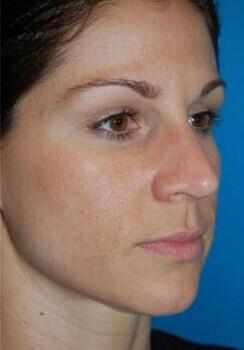 Blepharoplasty Before & After Image