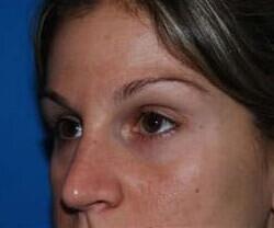 Blepharoplasty Before & After Image
