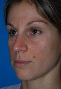 Blepharoplasty Before & After Image