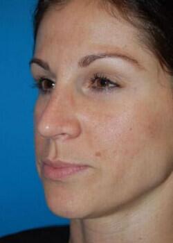 Blepharoplasty Before & After Image