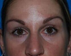 Blepharoplasty Before & After Image