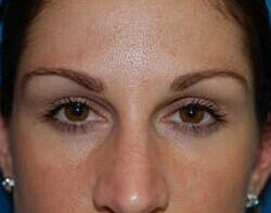 Blepharoplasty Before & After Image