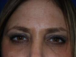 Blepharoplasty Before & After Image