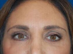 Blepharoplasty Before & After Image