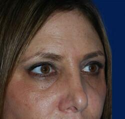 Blepharoplasty Before & After Image