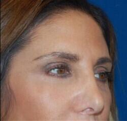 Blepharoplasty Before & After Image