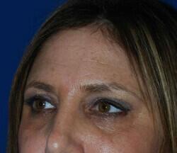 Blepharoplasty Before & After Image