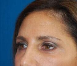 Blepharoplasty Before & After Image